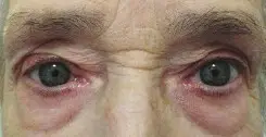 Αποκατασταση_βλεφαροπτωσης_μετα_απο_χειρουργικη_επεμβαση1.jpg