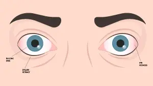 Ομιλία για την Δυσθυρεοειδική Οφθαλμοπάθεια