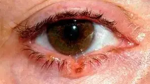 Ηλιακή ακτινοβολία &amp; όγκοι βλεφάρου: τι πρέπει να γνωρίζουμε και τι να προσέχουμε